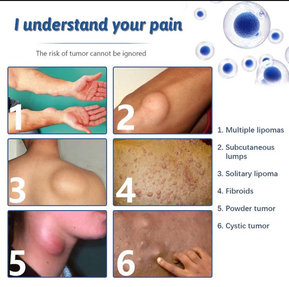 Lipoma Removal Cream