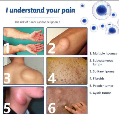 Lipoma Removal Cream